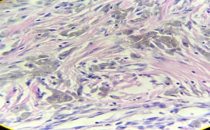 Figure 5: Spindle to Epitheliod Neoplastic Cells with Nuclear Atypia (400x H&E).