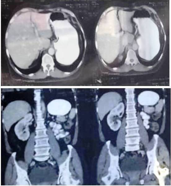 Figure 2: CT scan of abdomen and pelvic (after treatment).