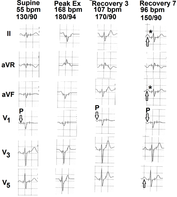 Figure 3: Selected electrocardiographic leads from the treadmill test of the third case. Resting supine electrocardiogram is normal. There is no electrocardiographic evidence of myocardial ischemia during exercise and recovery. Terminal negative deflection of the P wave in lead V1 (marked as ⇩) is more than 0.04 mm sec from third minute of recovery to seventh minute of recovery. There is mild prolongation of the P-R interval during recovery (marked as ∗). There is mild increase in the amplitude of P wave in leads II, aVF and V5 (marked as ⇧).