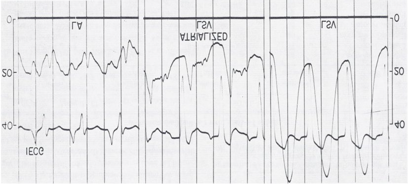 Figure 3: Simultaneous recording of intra-cardiac electrocardiogram (ECG) and pressures as the electrode/pressure recording catheter is slowly withdrawn from the left atrium (LA) to the left-sided, morphology-right ventricle (LSV). The left panel shows the atrial pressure curve with an atrial electrogram. The middle panel shows the atrial pressure curve with a ventricular electrogram when the tip of the catheter is in the atrialized ventricular chamber. The right panel shows the ventricular pressure curve with a ventricular electrogram when the tip of the catheter is in the ventricular chamber. Pressure is marked in mmHg. The pressure in LSV is damped because of the small diameter of the catheter. Reproduced from Rogers JH, et al. [5].