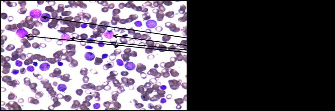 Figure 8: BM biopsy showing infiltration by abnormal lymphoid cells, Hematoxylyn and Eosin (H &E) stain, 4 X;