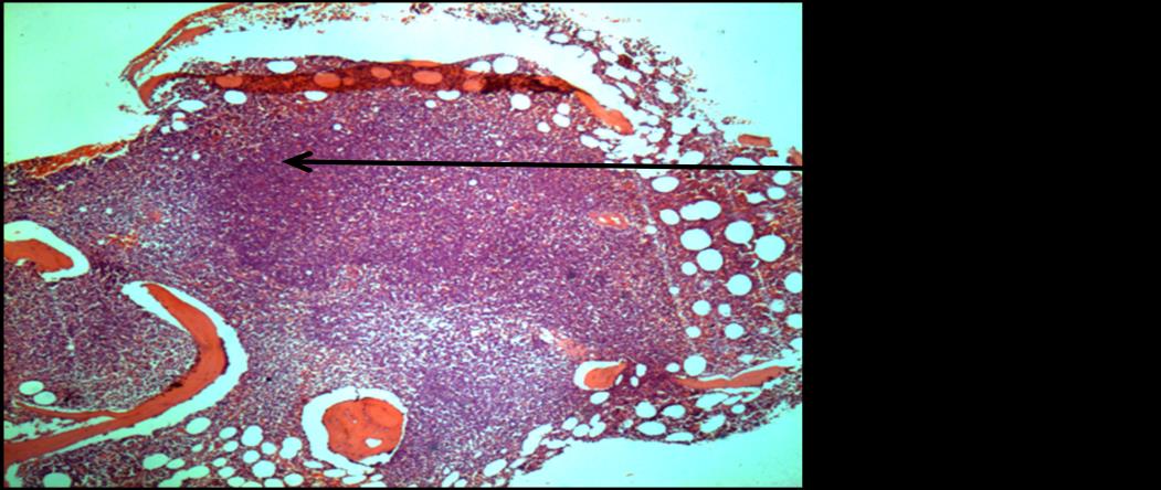 Figure 9: BM biopsy showing sheets of abnormal lymphoid cells, H &E stain, 50 X, oil immersion field.