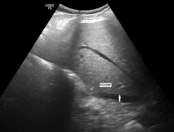 Figure 2: A longitudinal scan of VCI in expiration (arrow).