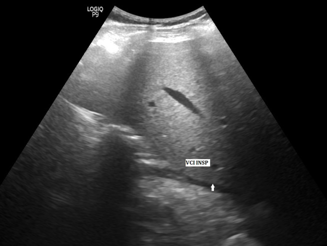 Figure 3: A longitudinal scan of VCI in inspiration (arrow).