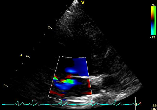 Figure 3: Doppler echocardiography. Left atrioventricular valve with a thickened appearance of its cusps. The Doppler study and color flow mapping show mild insufficiency.