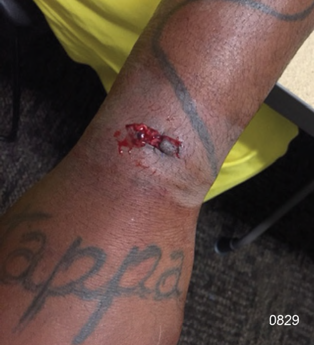Figure 11: The bullet/bracelet wound on Harris’ left dorsal wrist; a link of the bracelet gouged into his skin along with the bullet that hit the bracelet.