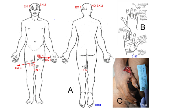 Figure 7: Autopsy of the victim. A. Anterior and posterior drawing of the body of the victim showing the locations and tracks of bullet wounds 1 through 5; red notes and arrows by the author. The lack of bullet strikes on the mailroom/ laundry walls from the bullets through the legs indicate these shots occurred elsewhere prior to the shots in the mailboxes/laundry room. B. Drawings made of the victim’s right hand showing the bullet wound; the extensive tissue tearing suggest a close-range shot, although no searing or gunpowder was observed associated with the wound. C. Image of the right hand gunshot wound at autopsy.