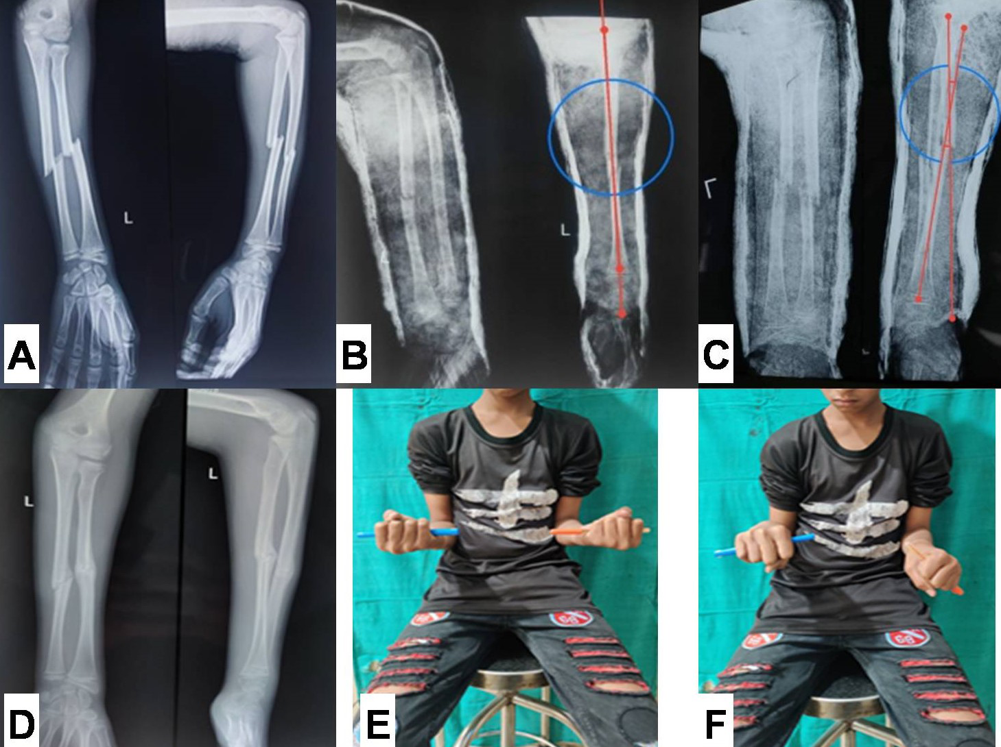 Figure 1: A: Pre-reduction plain radiograph showing both bone forearm fracture in 14 year old boy. B: Immediate radiograph following closed reduction showing acceptable reduction. C: Radiograph at 2-weeks, showing angulation of 11˚ (outside range of acceptable limits). D: Radiograph showing united fracture with remodelling of angulation. E & F: Clinical photograph showing full supination with terminal 20˚ of pronation restriction.