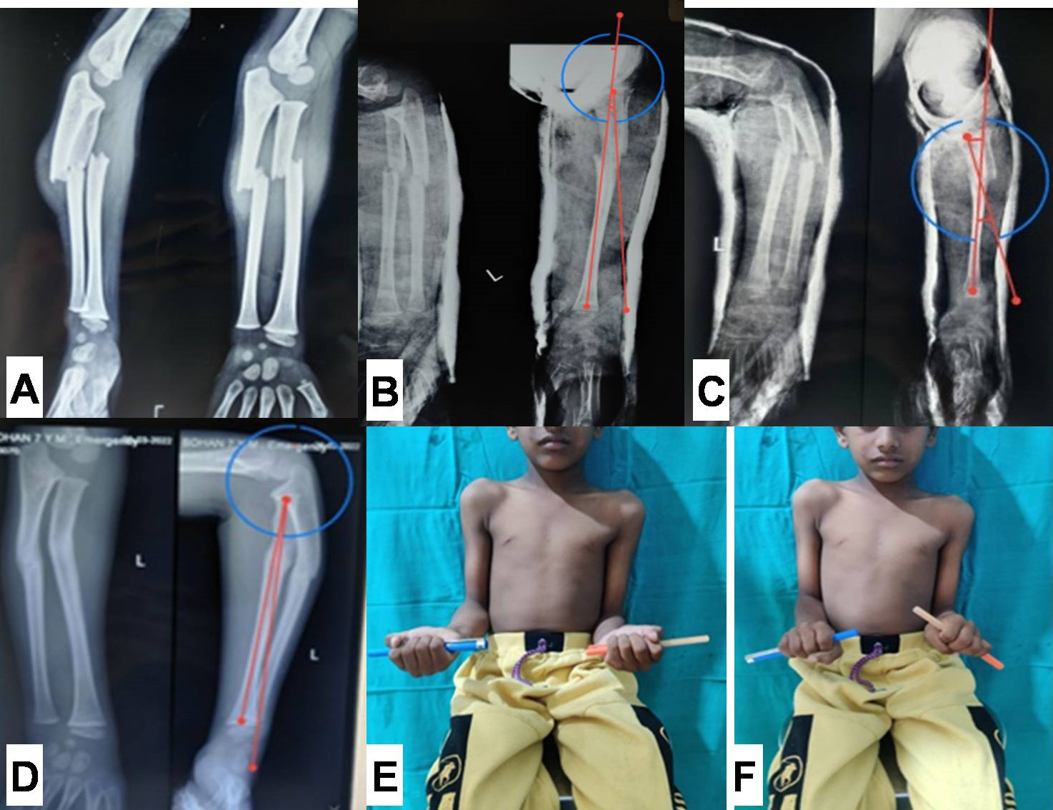 Figure 2: A: Pre-reduction plain radiograph showing both bone forearm fracture in 7 year old boy. B: Immediate Check radiograph showing an angulation of 8.6 degrees (acceptable Range). C: Radiograph at 2-weeks, showing angulation of 18.5˚ (outside range of acceptable limits). C: Radiograph showing united fracture with remodelling of angulation (3.6˚ of angulation). E & F: Clinical photograph showing full supination with terminal 10˚ of pronation restriction.