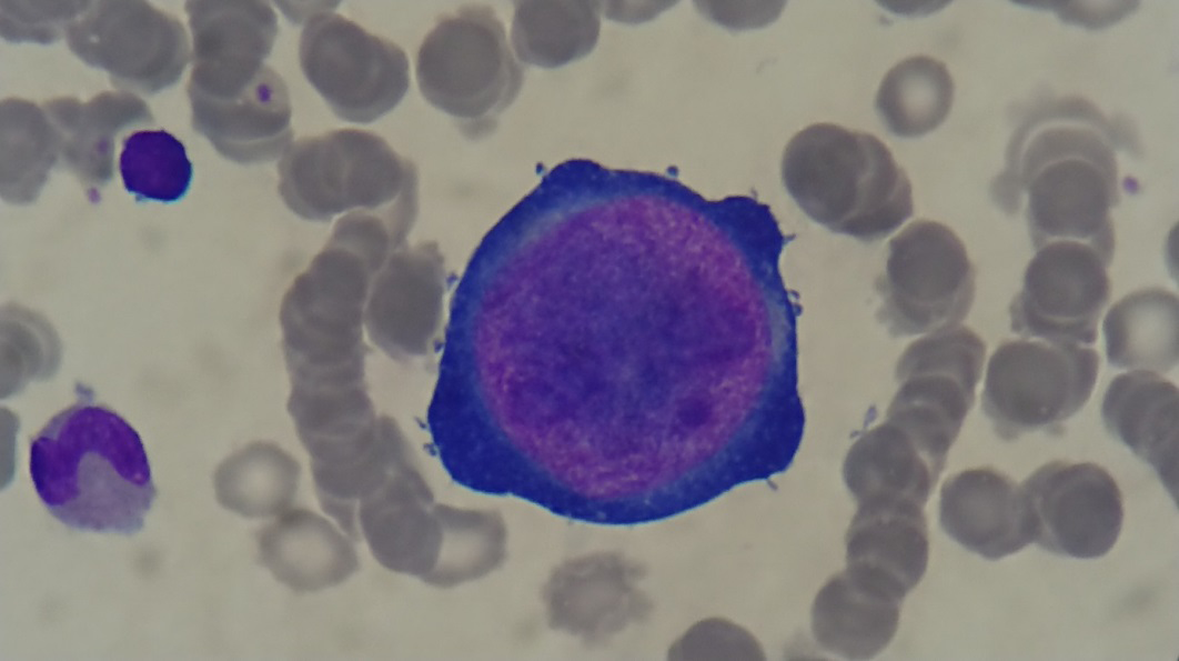 Figure 1: “Giant” proerythroblasts with intranuclear eosinophilic inclusion bodies like nucleoli and the absence of late normoblasts in the bone marrow.