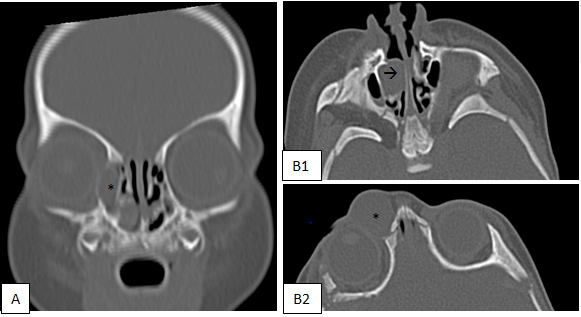 Figure 3: Computed Tomography A: Coronal. B1, B2: Axial. *Dacryocele, à Intranasal Mucocele