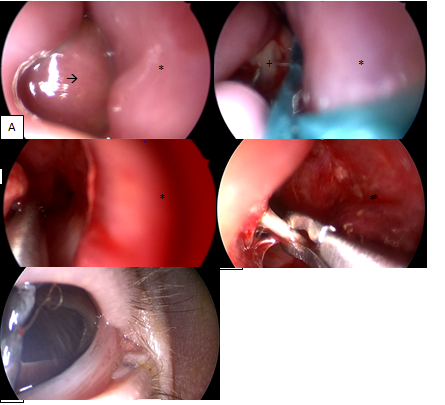 Figure 4: Patient at Operating Room. A. Mass at the Inferior Meatus at the Right Nostril with 0° Endoscopic Vision. B. Opening of the Mass with Pus. C. Resection and Marsupialization of the Medial Wall. D. Intranasal Identification of the Probe. Irrigation was performed. E. Monoka® Properly Installed by O Ophtalmologist at Inferior Canaliculus. * Septum, à Mucocele Intranasal, Inferior to Inferior Turbinate, + Pus.