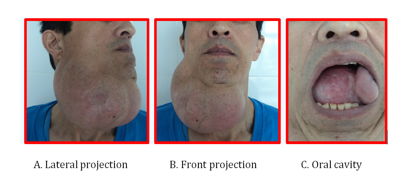 Figure 1: General view of a 50-year-old patient before treatment From the anamnesis, the tumor appeared 8 years ago. At his place of residence he contacted doctors and they discovered a tumor in the submandibular region and offered surgery to remove the tumor, but the patient refused the proposed operation. After this, the patient did not go to the doctors. In March 2015, due to the appearance of pain and an increase in tumor in the submandibular area on the right, the patient contacted our clinic.