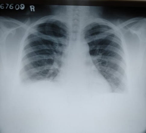 Figure 1: Chest X-ray.