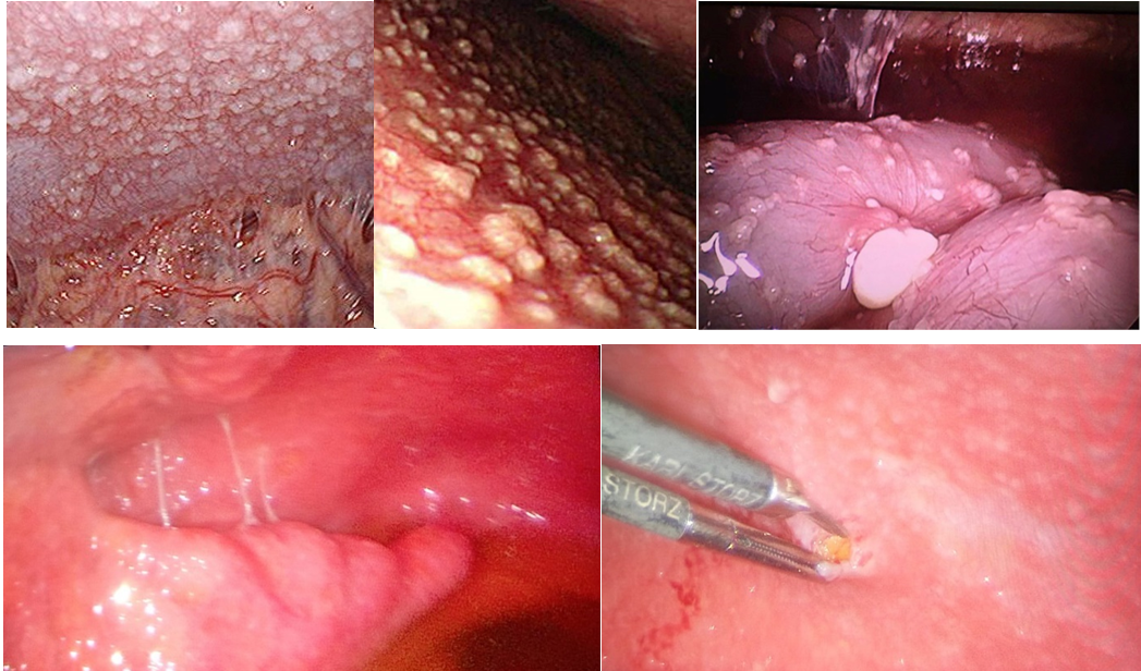 Figure 2: Laparoscopic view of the peritoneal cavity (From left to right- Parietal peritoneum with adhesions, liver surface, bowel surface, thickened omentum and parietal peritoneum).