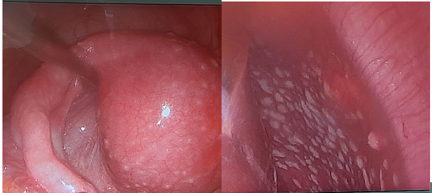 Figure 3: Laparoscopic view of the uterus (left) and liver surface (right).