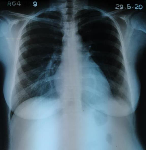 Figure 5: Chest X-ray.