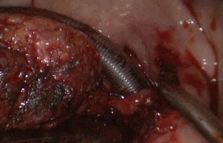 Figure 1: Adenoid-Cyst Carcinoma- A: MRI; B: Transoral Tongue Base Resection (Endoscopic Vision); C: Postoperative MRI.