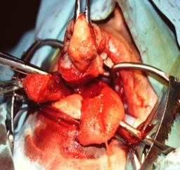 Figure 3: Total Glossectomy – A: Transoral Endoscopic Resection; B&C: Anterolateral Thigh Free Flap.