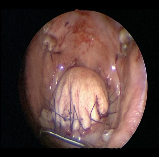 Figure 5: Central Oral and Tongue Base Glossectomy for Sleep Apnea.
