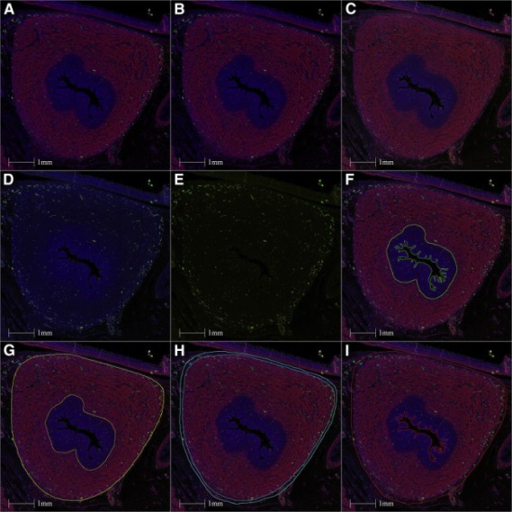 Figure 1: Courtesy ref no-9-Illustration of the use of immunofluorescence images to perform nerve quantification with the “HALO” software. Section of the uterine body treated with triple SMA-TH-NPY labeling, with DAPI. Each fluorochrome can be “switched off” or “switched on” depending on what we want to visualize. This illustration shows the centripetal disposition of the innervation of the uterus. (A) SMA + TH + NPY + DAPI. (B) SMA + TH + DAPI. (C) SMA + NPY + DAPI. (D) TH + NPY + DAPI. (E) TH + NPY. (F) Endometrial contouring. (G) Myometrium contouring. (H) Contouring of the serosa. (I) Contouring of the whole uterus. DAPI = 6-diamidino-2-phénylindole; NPY = neuropeptide Y; SMA = smooth muscle actin; TH = tyrosine hydroxylase.