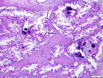 Figure 1: MiT family translocation renal cell carcinoma delineating papillary structures and alveolar configuration composed of clear cells imbued with voluminous cytoplasm and pleomorphic nuclei. Surrounding stroma exhibits psammoma bodies [6].