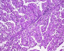 Figure 2: MiT family translocation renal cell carcinoma exhibiting papillary structures with fibro-vascular cores and alveolar articulations comprised of clear cells and eosinophilic cells pervaded with voluminous cytoplasm and pleomorphic nuclei [7].