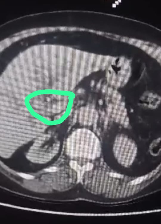 Figure 1: CT abdomen showing an ill-defined hypodense focal lesion measuring 3x1.7cm.
