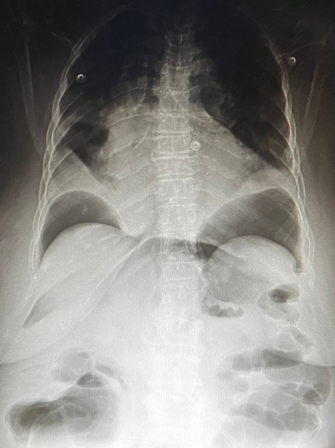 Figure 2: Plain X ray abdomen in erect position showing marked amount of air under diaphragm.