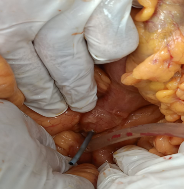 Figure 3: Migrated stent causing perforation of the small intestine at DJ.