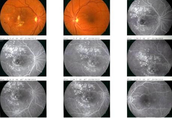 Figure 10: Colour Fundus Photo of both eyes .Right fundus showed fibrosed macroaneurysm with reduced hard exudates. The FFA demonstrated RPE defect and scar staining but no sign of activation like dye leakage, retinal pigment epithelium alterations at the site of the laser spot application.