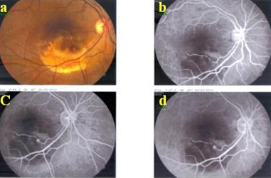 Figure 11: a) Colour photograph of right eye showing a retinal arterial macroaneurysm surrounded by retinal exudates along the inferotemporal arcade. b,c,d) FFA at baseline revealed a fusiform hyper fluorescent lesion corresponds to RAM along inferior arcade, and block choroidal corresponds to hard exudates.