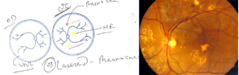 Figure 3: Reduction of macular oedema and hard exudates in left eye.