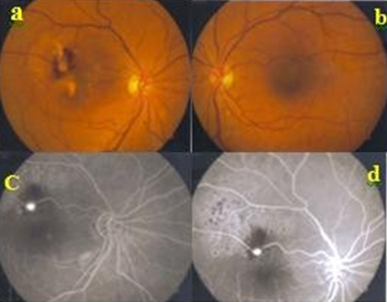 Figure 5: Optical coherence tomography at the end of follow-up with ﬂuid and hard exudate disappearance.