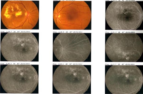 Figure 8: Colour Fundus Photo of both eyes .right fundus photo showed fibrosed RAM surrounded with laser scar and huge hard exudate and mild NPDR in both eye. FFA right eye did not revealed any leakage, it showed only window defect corresponds to RPE atrophy and staining of laser scar.