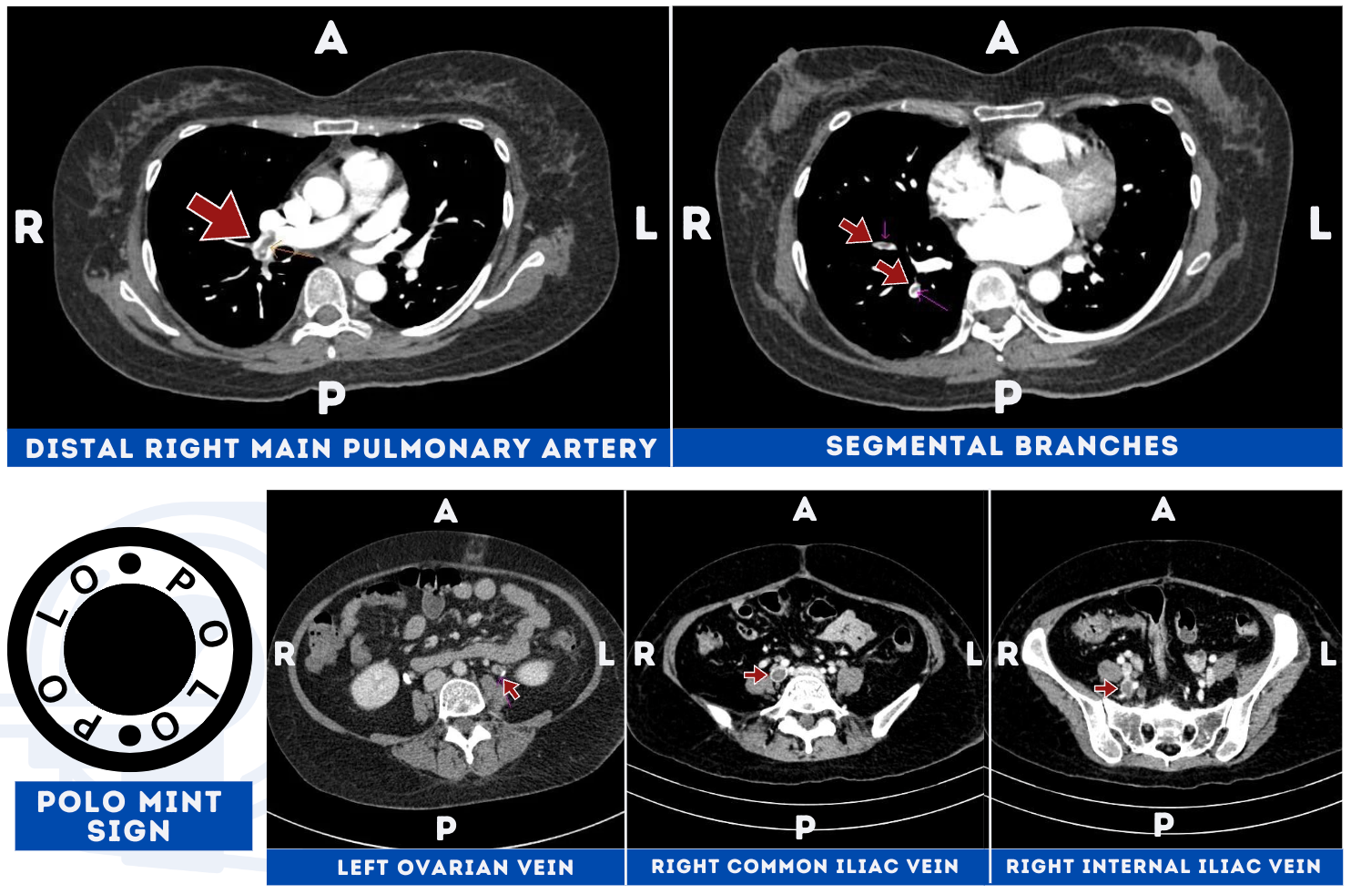 Figure 1: Computed Tomography Images showing Venous Thromboembolism through visualization of the Polo Mint Sign on the (1) distal right main pulmonary artery and its segmental branches, (2) left ovarian vein, (3) right common iliac vein, (4) right internal iliac vein.
