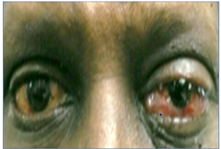 Figure 1: External appearance of the left eye with proptosis, ptosis, and conjunctival chemosis 72-hours following bisphosphonate infusion.