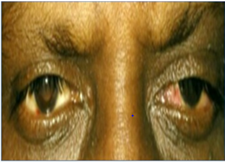 Figure 3: complete resolution of ocular signs by day-10 after treatment with topical steroids.