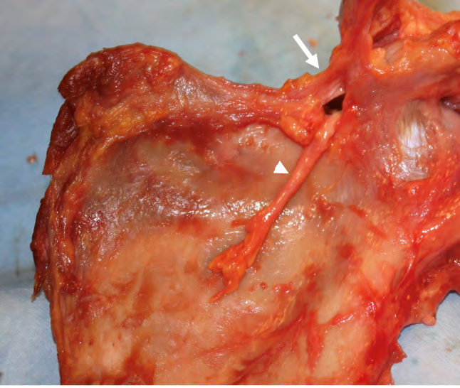Figure 1: Anterior view of a right scapula. The suprascapular nerve (arrowhead) is seen to enter the suprascapular notch, which is bordered cranially by the superior transverse scapular ligament (STSL, arrow).