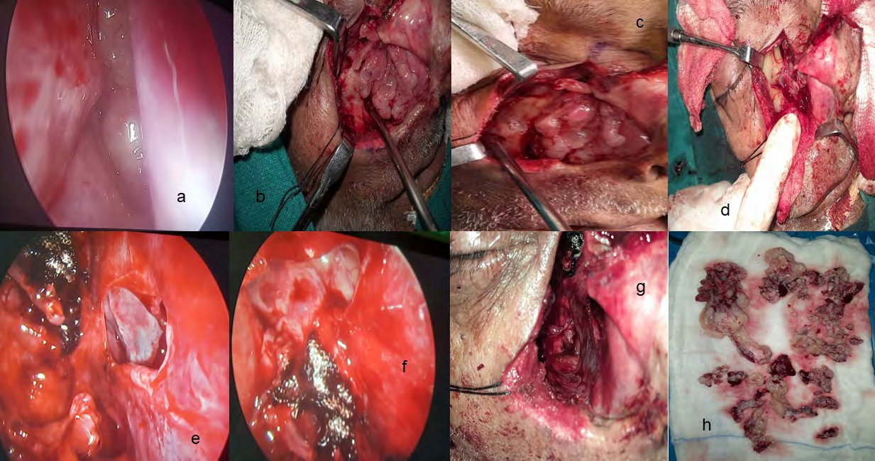Figure 1: A: Endoscopy Revealed a Mass in the Left Nasal Cavity; B: Mass Evident on Lateral Rhinotomy Incision; C&D: After Bony Removal of Anterior Maxillary Wall and Inferior Orbital Margin; E: Septal Perforation due to Mass; F: Endoscopy of the Frontal Sinus; G: Cavity after Total Mass Removal; H: Excised Tumor.