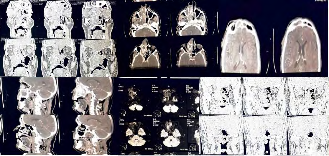 Figure 2: NCCT –PNS (Non-Contrast Computed Tomography- Paranasal Sinus) Revealed Poorly Defined Infiltrative Soft Tissue Sinonasal Mass Involving the Right Ethmoid Air Cells, Bilateral Frontal Sinuses(R>L), with Extension into the Right Nasal Cavity with Intra-Orbital (Right Medial Extra Conal Space) and? Intracranial Extension and Bony Destruction of the Right Frontal Sinus, Right Lamina Papyracea, Medial Wall Right Maxillary Sinus, Septum.