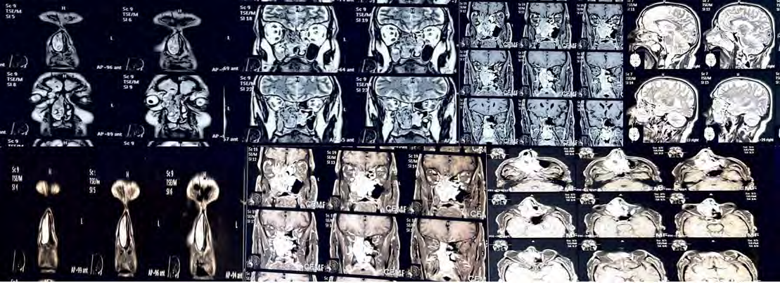 Figure 3: CE-MRI Brain, Orbit And PNS Revealed a Large Heterogenous Sinonasal Mass Centered in the Right Nasal Cavity with Involvement of Bilateral Ethmoid Cells with Lateral Extension in the Right Maxillary Sinus and Superior Extension into the Bilateral Frontal Sinus. The Mass Appeared Isointense on T1W and Heterogenously Hyperintense on T2W FAT Sat Images with T2W Hypointense Areas Giving a Cerebriform Appearance. Multiple Foci of Calcifications were seen within it. Left Lateral Displacement and Erosion of Septum, Destruction of Right MT & IT, Uncinate, and Medial Wall of the Maxillary Sinus was Noticed. Superolaterally, it was causing the Destruction of the Right Lamina Papyracea and the Extension of Mass into Medial Extraconal Space of the Right Orbit Displacing the Globe Laterally. It was also Causing Erosion of The Anterior and Posterior Walls of the Frontal Sinus (Right), However, no Gross Intracranial Extension was Seen. Erosion of the Anterior Wall of the Sphenoid Sinus (Right) and Extension into Right Pterygopalatine Fossa with Mild Widening was also Reported.