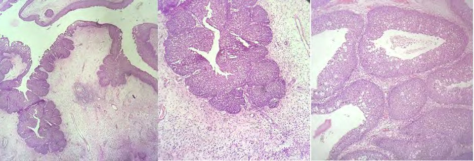 Figure 4: Histopathology of the Resected Specimen. A: Prominent Downward Endophytic Growth of Round to Elongated Interconnected Epithelial Nests with Smooth Outer Contour (H&E, X10); B: Invaginating Nests of Hyperplastic Epithelium, Respiratory Type with Focal Squamous Metaplasia (H&E,X40); C: Nests with Neutrophilic Microabscesses. Surrounding Stroma Shows Mild Edema with Chronic Inflammation (H&E, X10).