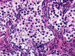 Figure 1: Gonadoblastoma demonstrating tubules lined by immature Sertoli cells, centric germ cells and surrounding basement membrane. Intervening stroma exhibits clusters of enlarged, polygonal cells akin to Leydig cells [5].