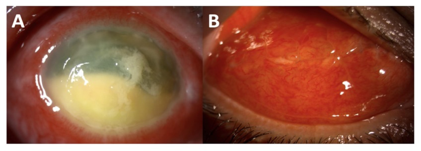 Figure 2: Uncontrolled microbial keratitis without spontaneous perforation (A). Anterior segment photography after immediate evisceration (B).