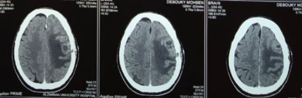 Figure 4: CT brain axial cuts shows a new developed abscess after aspiration of the first one instead of full intravenous antibiotics uses for 7days depending on culture and sensitivity obtained after first aspiration.