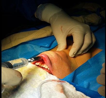 Figure 2: Using Veres needle, subplastimalhydro dissection with approximately 20cc of Normal Saline with Adrenaline (500cc Normal Saline + 1cc Adrenaline) was performed in 3 axes (central, right and left).