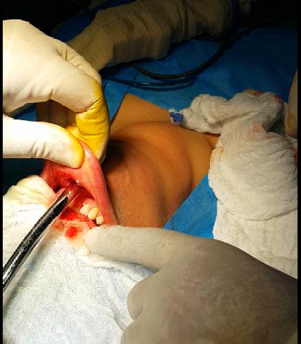 Figure 3: blunt dissection of the subplastimal plane with blunt dilator was performed in the same 3 axes of hydro dissection.