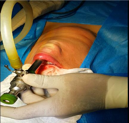 Figure 4: A 10mm central trocar for camera was placed through the vestibular incision and insufflations to 5-6 mmHg with CO2.