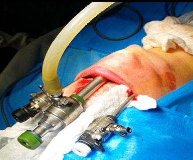 Figure 5: Two additional 5 mm trocar were placed under direct vision through two 5mm vertical incisions in both most lateral aspect of the vestibule at the level of the inferior molars, in order to prevent injury of the mental nerve. The sub-platyssmal plane was entered and dissected with ultrasonic energy device (Sonicbeat Olympus). The deep fascia was opened in the midline and strap muscles retracted with hanging sutures pass through the skin. The isthmus of the thyroid gland was identified and divided. The superior and inferior pedicles on the right side were identified and divided by ultrasonic energy device. Recurrent laryngeal nerve and parathyroid glands were identified and preserved. Subtotal excision of the right thyroid lobe with secured hemostasis was done. The right lobe was brought out through the oral cavity using an endobag. The same procedure was repeated on left thyroid lobe. Redivac drain was inserted through the skin to drain the surgical field. The deep fascia was closed using absorbable sutures and the vestibular port sites were closed in 2 layers using absorbable sutures. The operative time was (150 minutes); recorded from the beginning of vestibular incisions until complete closure of these wounds. No intraoperative complications were reported during this procedure. After recovery from general anesthesia, the patient transmitted to the surgical ward for follow-up. Injectable antibiotic was continued until the patient discharge from hospital. Oral diet was started on first postoperative day. The drain was removed on the first postoperative day containing only few cc of blood stain serous fluid. The patient was discharge from the hospital on the second postoperative day with no complications and given instructions to be continuing on oral antibiotic and mouth wash and to be re-examining at the end of first postoperative week, 2 weeks and 4 weeks.